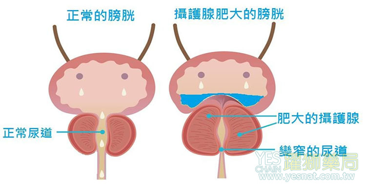 🚻 攝護腺肥大造成的排尿障礙|輔助療效值得關注 🚻 攝護腺肥大造成的排尿障礙|輔助療效值得關注